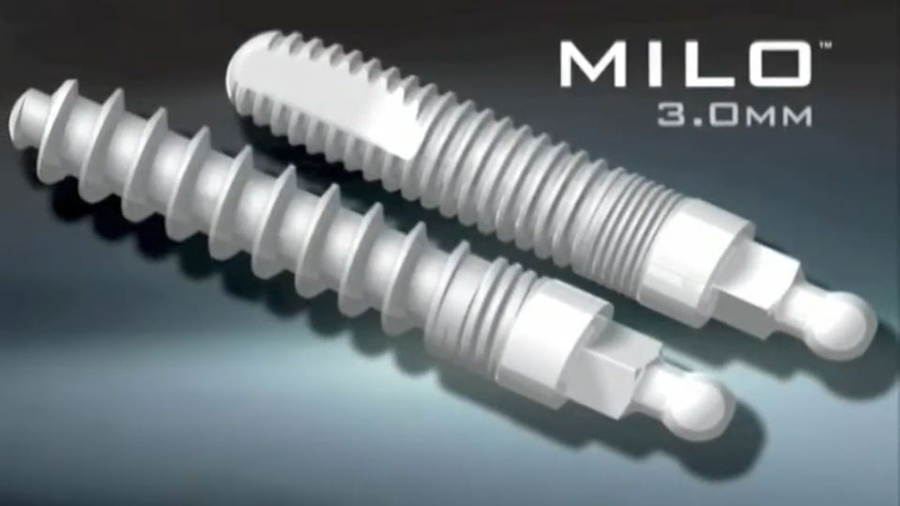 MILO 3.0mm Dental Implants
